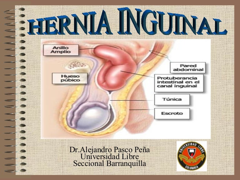 Hernia intestinal tratamiento